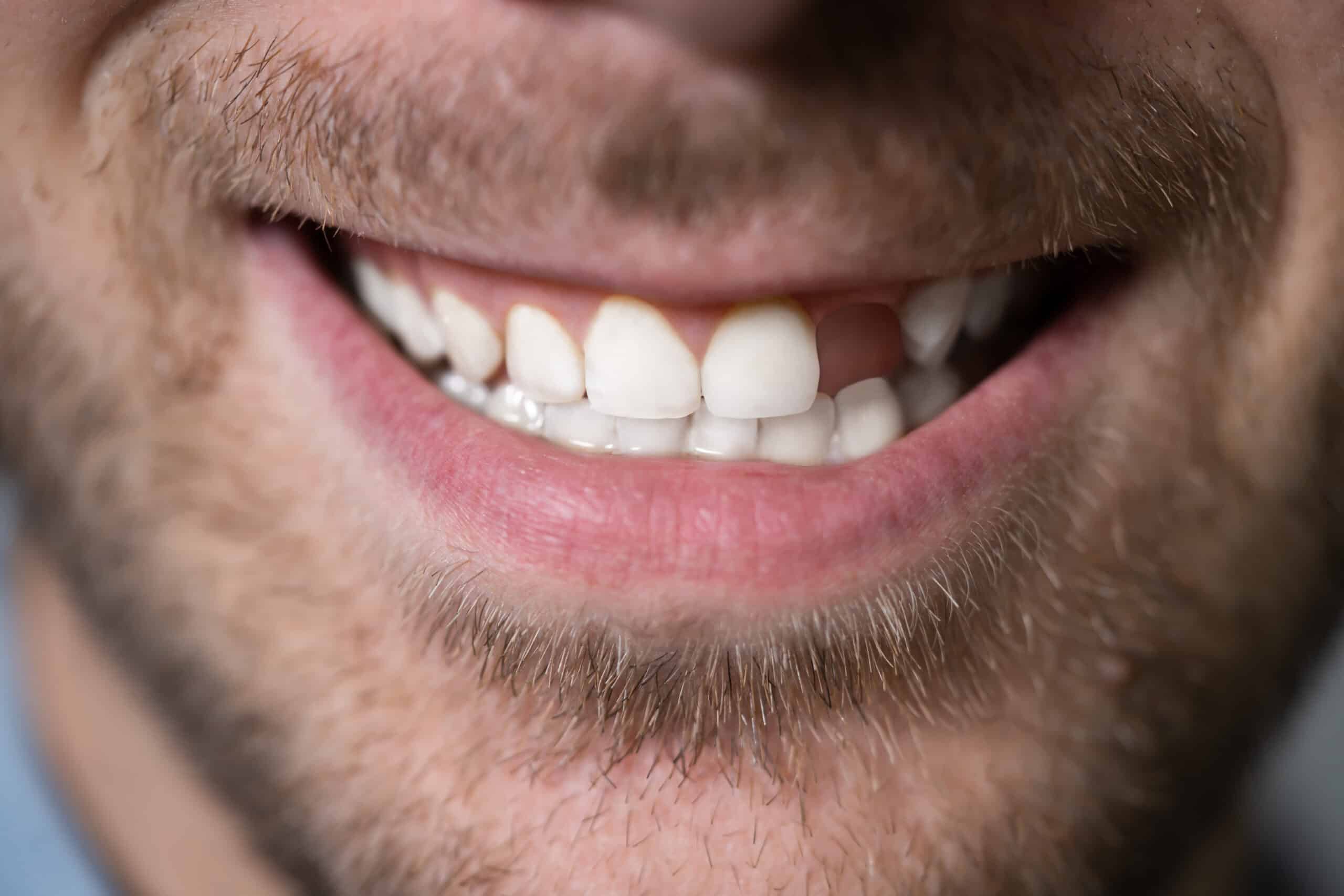aged denture dentures implanty pacjenta poradnik causes cennik dentysta