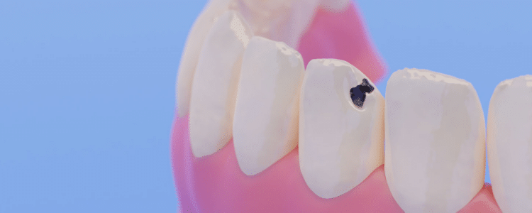 Cavity Capozzi Dental (2)