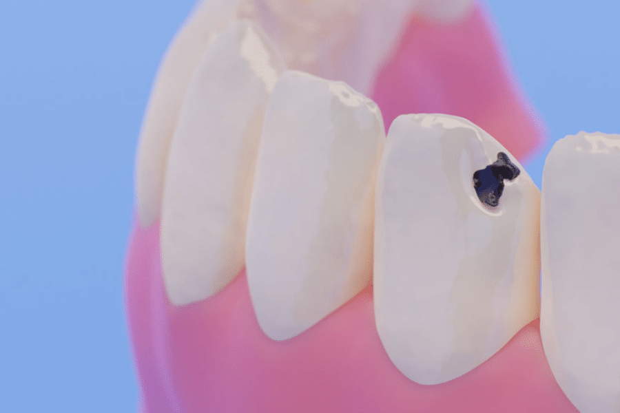 Cavity Capozzi Dental (2)