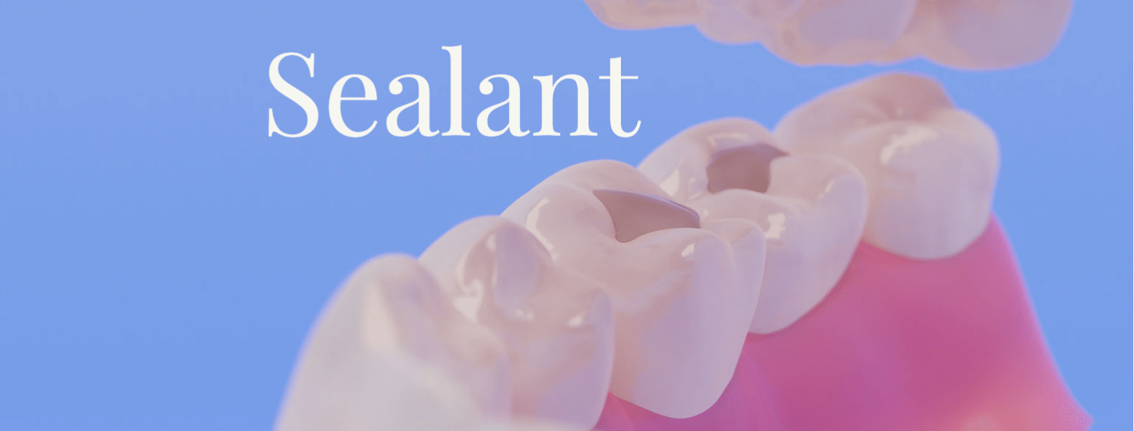 What is dental sealant? How can sealant help my teeth?