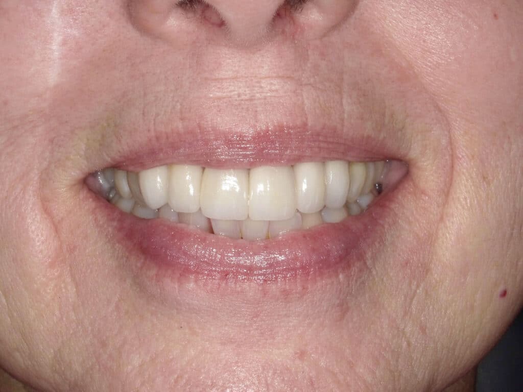 Smile restoration in Lewisberry, PA
