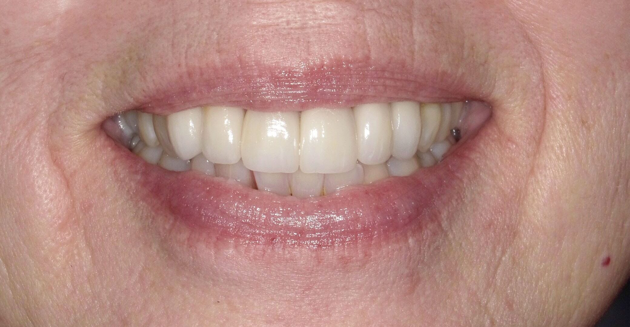 Smile restoration in Lewisberry, PA