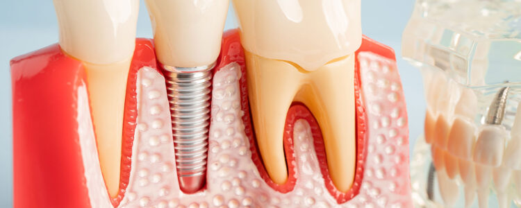 Dental Implants in Etters, PA